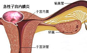 子宫内膜炎怎么治疗才好